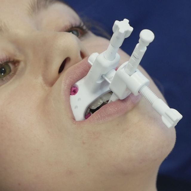 SleepLikeMe-Medical GmbH & Co.KG JS-Gauge im Mund